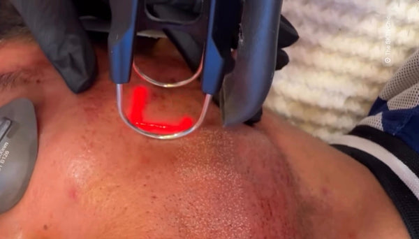 Tetra PRO CO2 Laser for Acne Scars