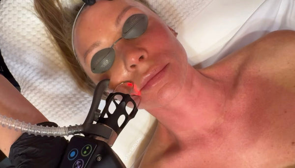 Boost Collagen Naturally with CO2 Laser Treatments