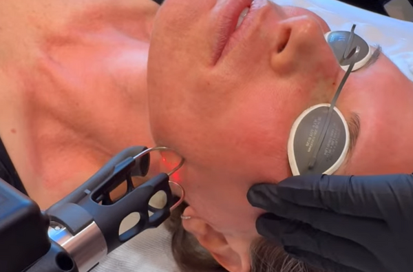 Why You Should Treat Your Face, Neck, and Chest Together During Laser Treatments