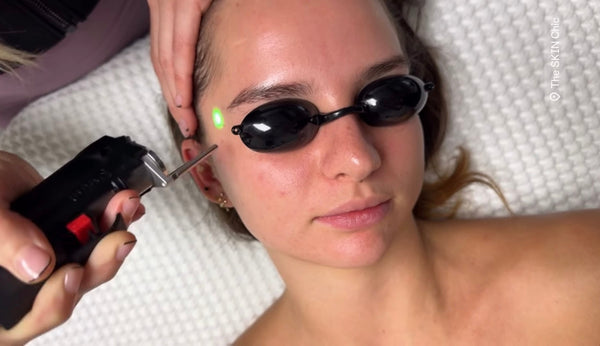 Upper Lip Laser Hair Removal in Virginia Beach