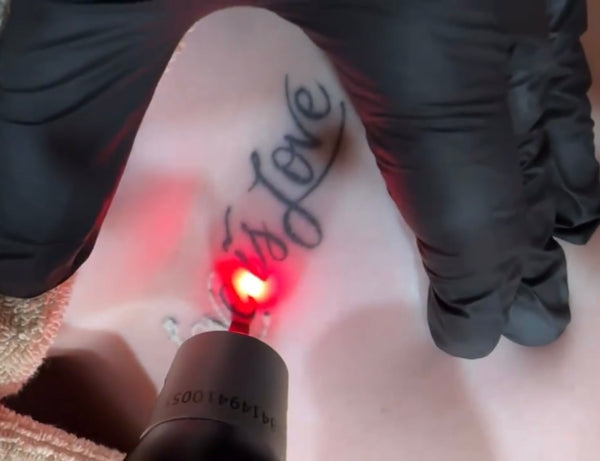 The Ultimate Guide to PicoSure Pro Tattoo Removal