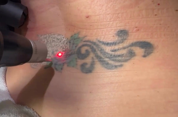 PicoSure Pro laser tattoo removal in Virginia Beach - tattoo removal on lower back with the PicoSure Pro laser