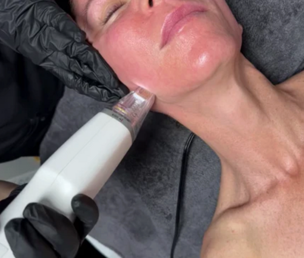 Microneedling Before & After: What to Expect From Your Results
