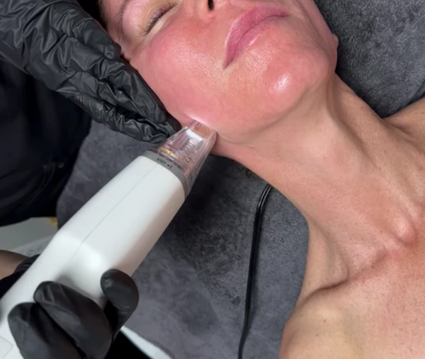 Glow Deeper: The Ultimate Microneedling Guide