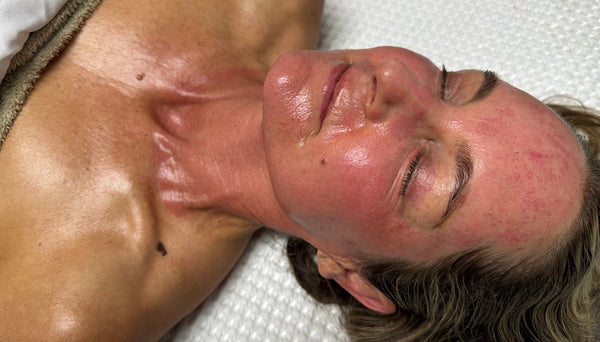 How Much Does Microneedling Cost in Virginia Beach?