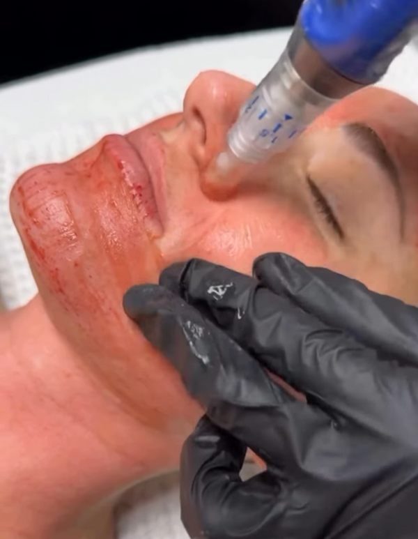 Microneedling for Brides: Lift, Smooth, and Glow Before You Say “I Do”