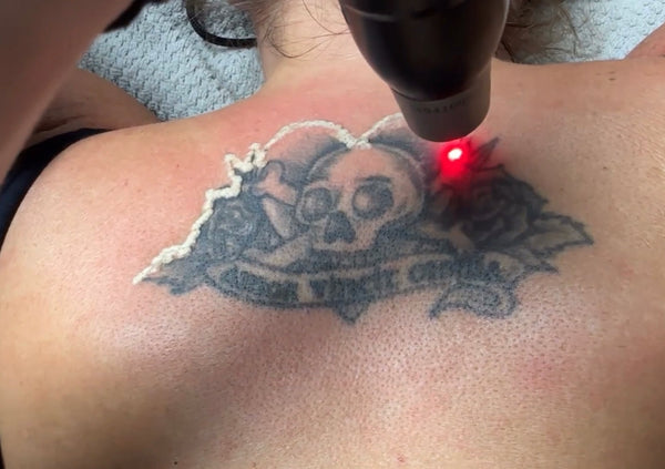 Tattoo Removal in Virginia Beach: 8 Reasons Why We Love PicoSure Pro
