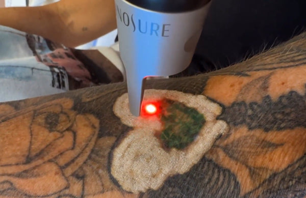 Tattoo Removal with the PicoSure Pro Laser