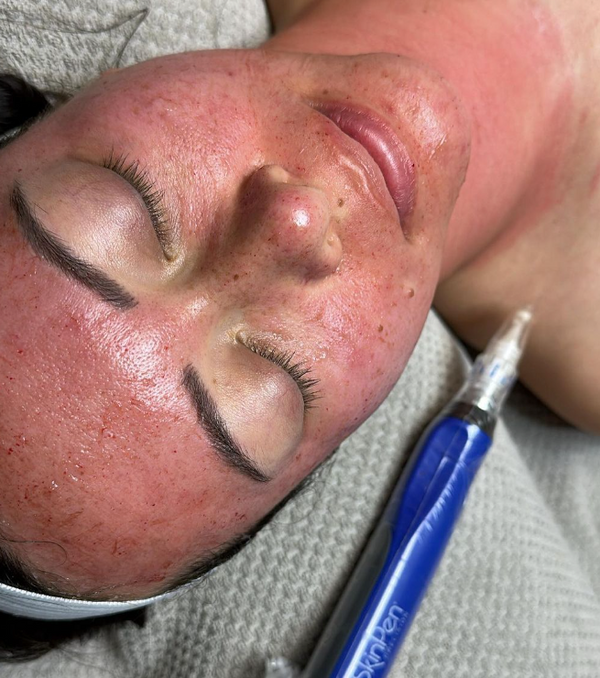 Boost Your Collagen Naturally with Microneedling Treatments