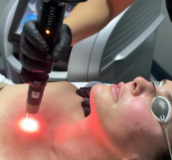 How PicoSure® Pro Laser Treats Melasma