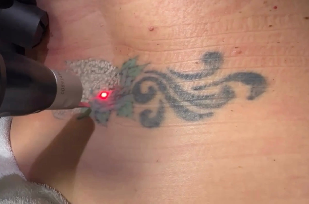 Laser Tattoo Removal in Virginia Beach: Your Ultimate Guide