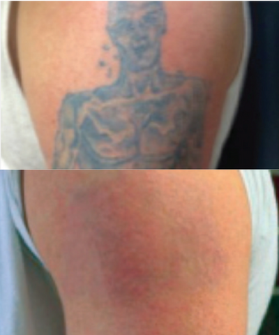 Tattoo Removal Near Me